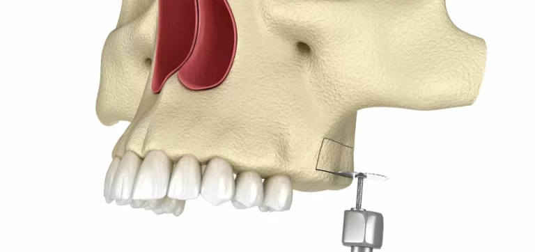 sinus lifting