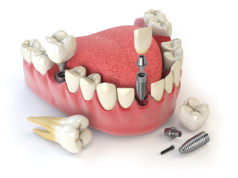 Tooth human implant.