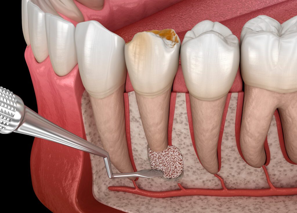 endodontic surgery