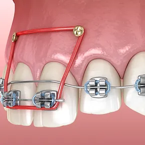 Orthodontic implants