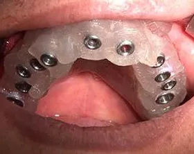 implant