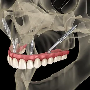 Zygomatic-implants