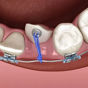 exposing trapped teeth