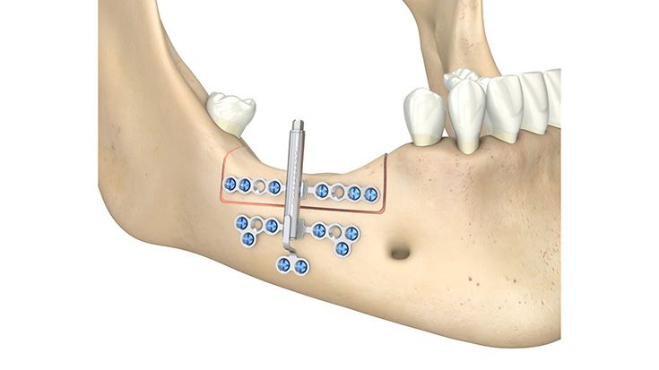 Alveolar Distraction - Start